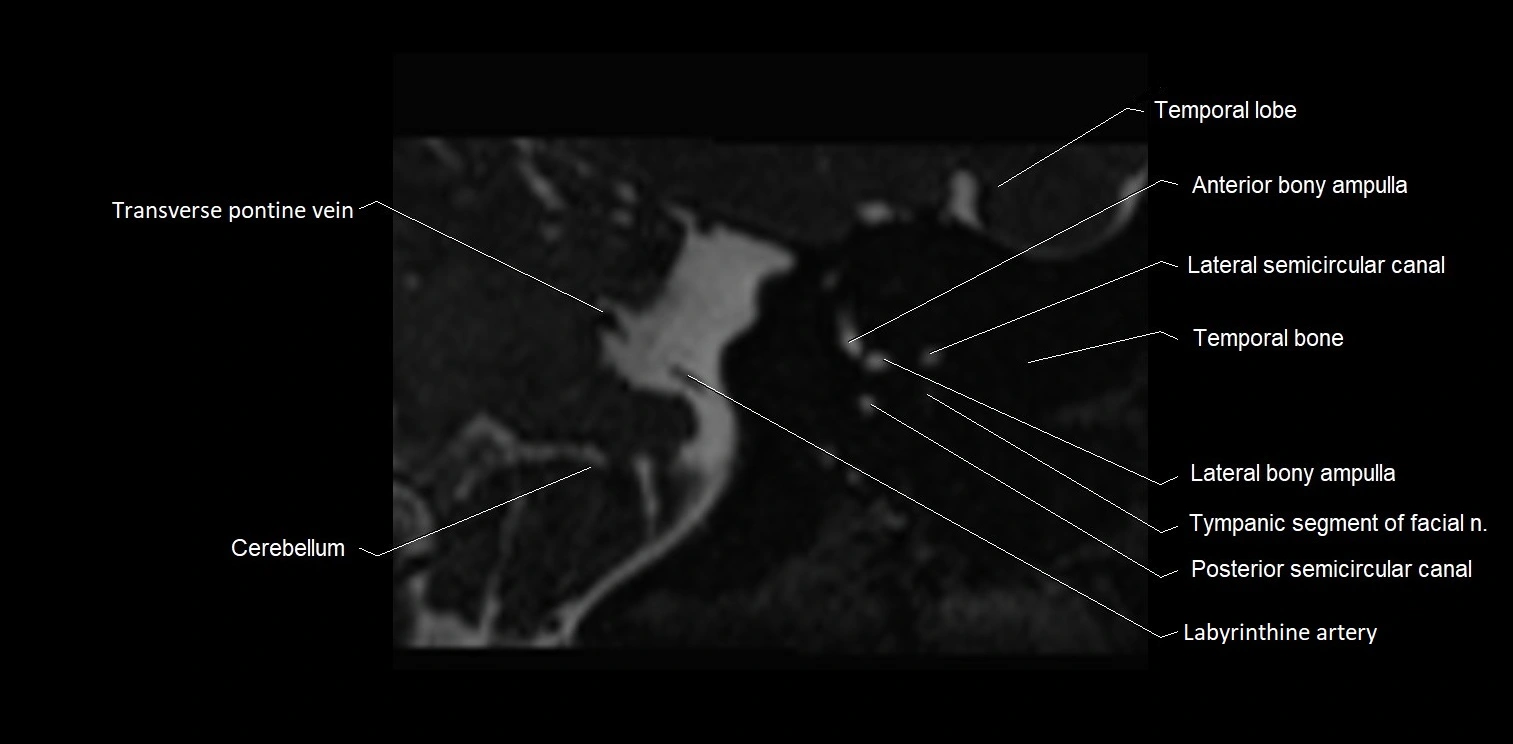 MRI Internal auditory meatus (IAM) coronal cross sectional labelled anatomy image 26.webp